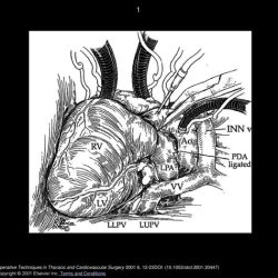 Mammary artery body harvesting sternotomy median epigastric anastomosis